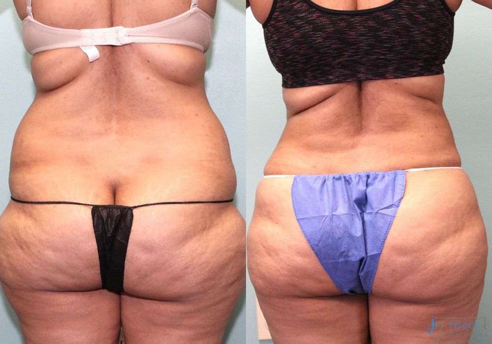 Lipo 360 - Case 2322