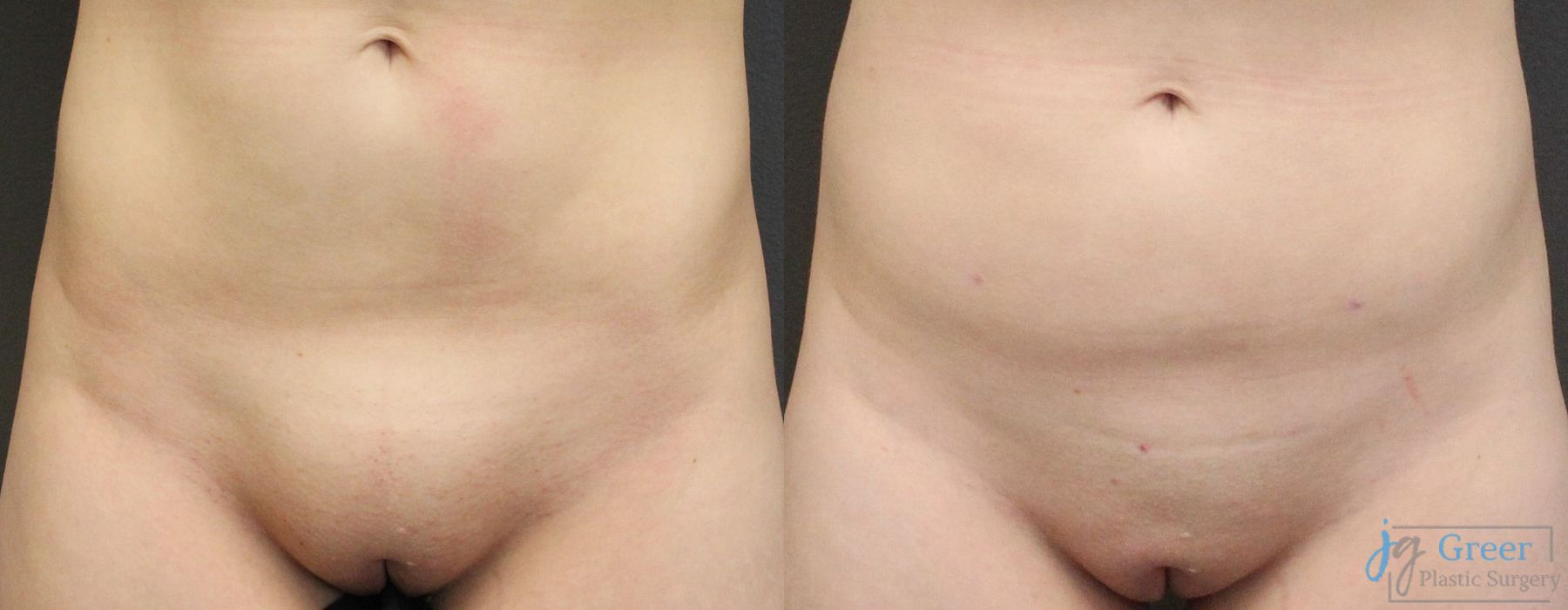 Liposuction - Case 2328