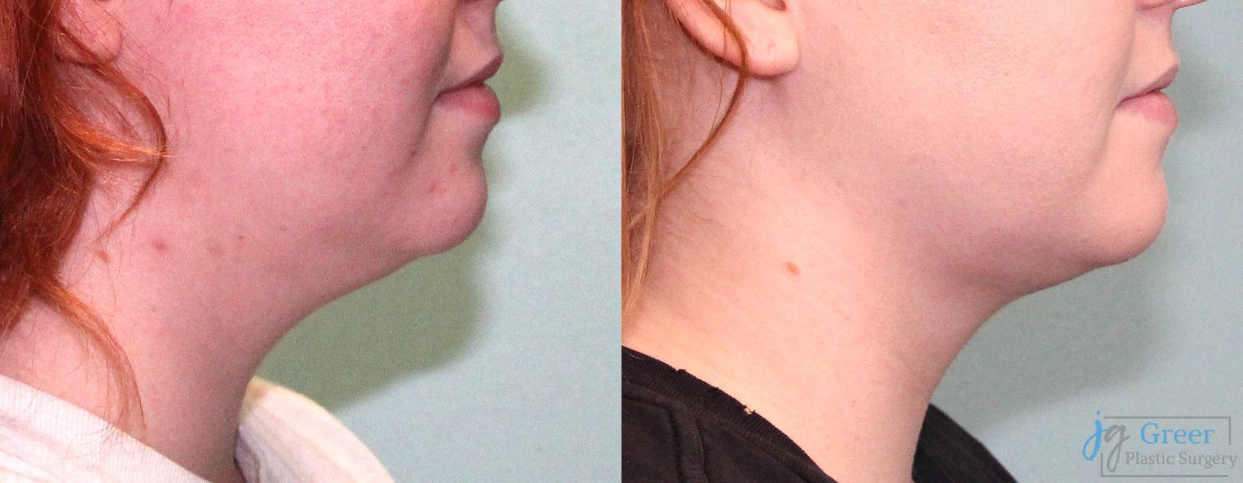 Liposuction - Thumbnail 2