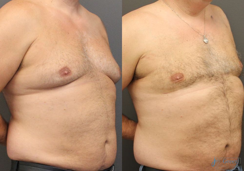 Gynecomastia - Thumbnail 2