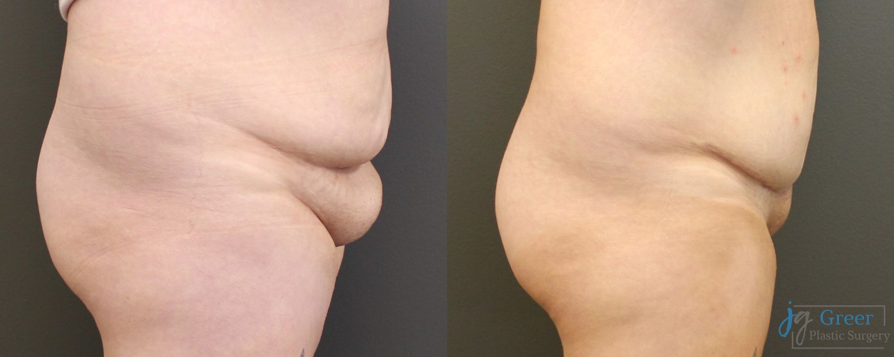 Before and after Monsplasty case 19873 - Angle 2