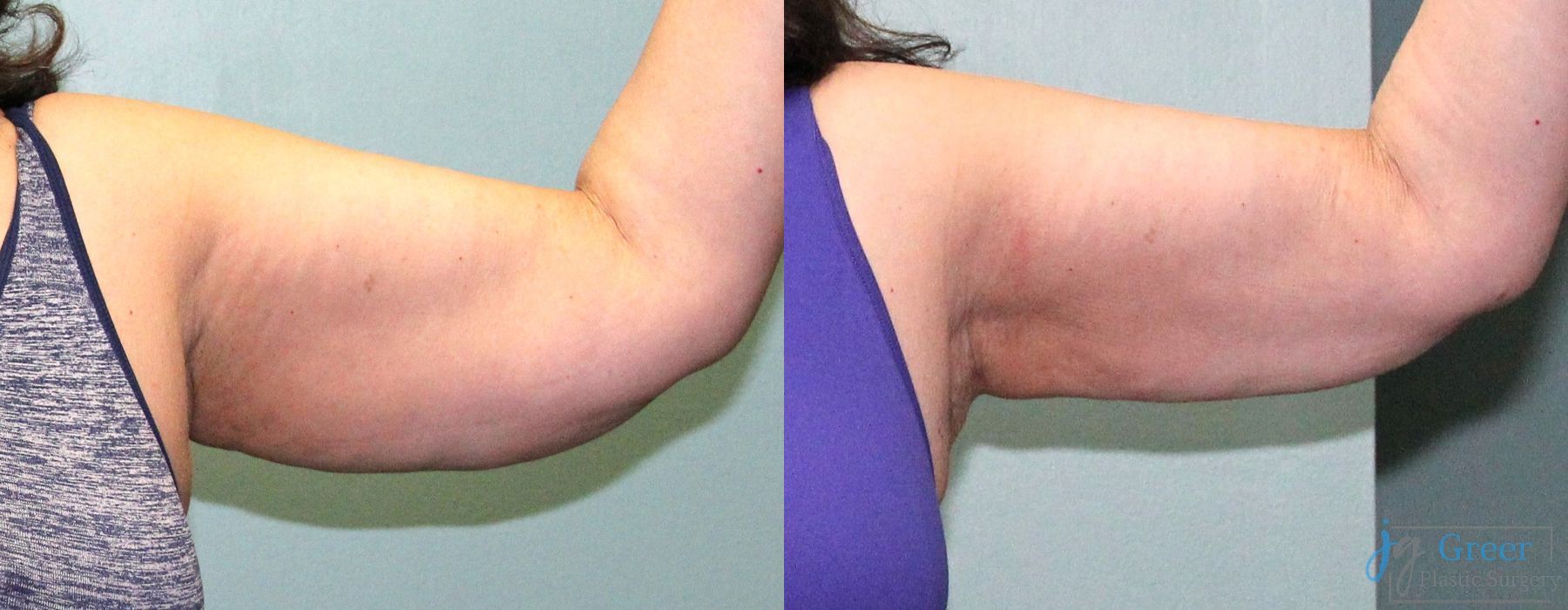 Liposuction - Thumbnail 3