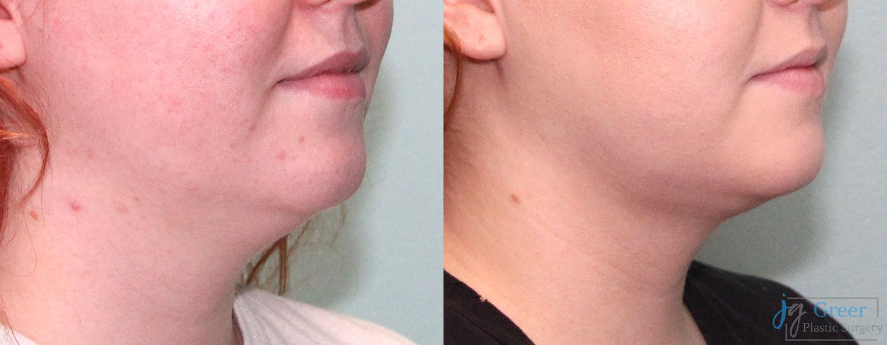 Liposuction - Thumbnail 3