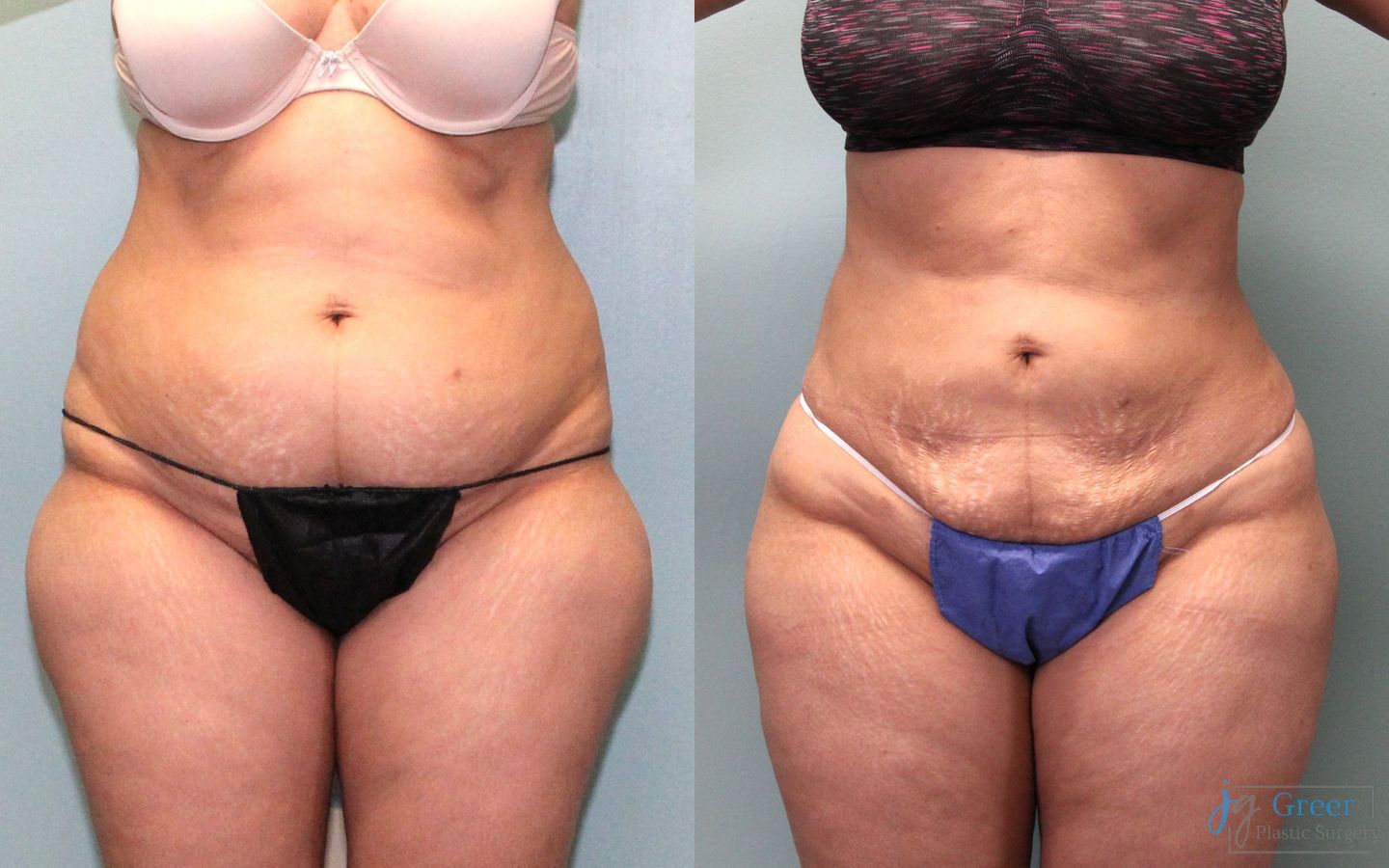Before and after Liposuction case 19865