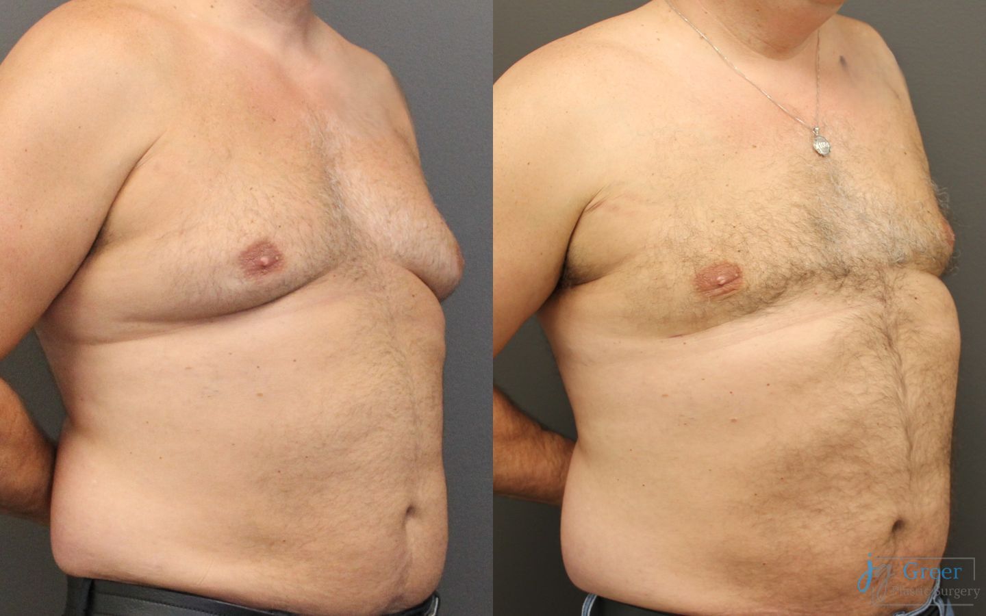Before and after Liposuction case 19874 - Angle 3
