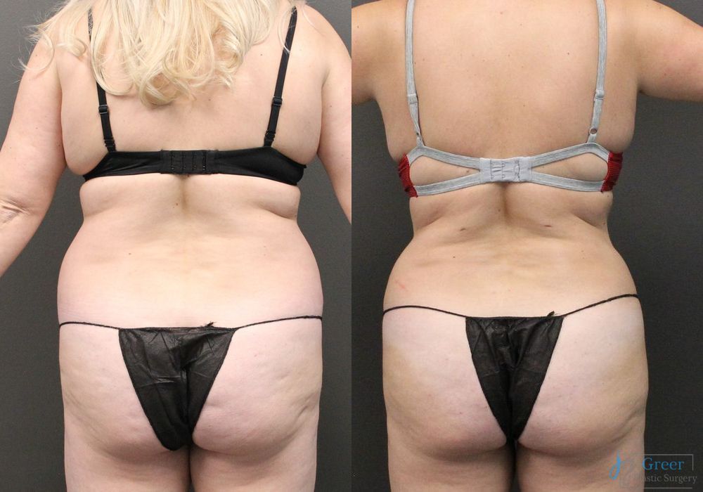 Liposuction - Thumbnail 2