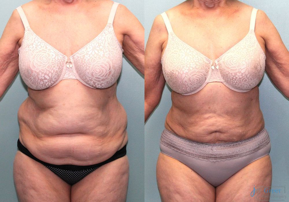 Liposuction - Case 2323