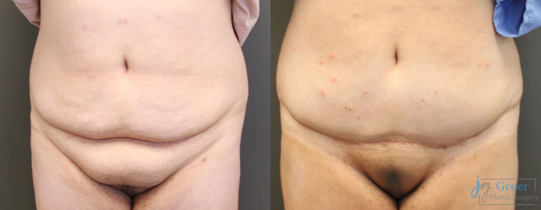 Before and after Liposuction case 19873