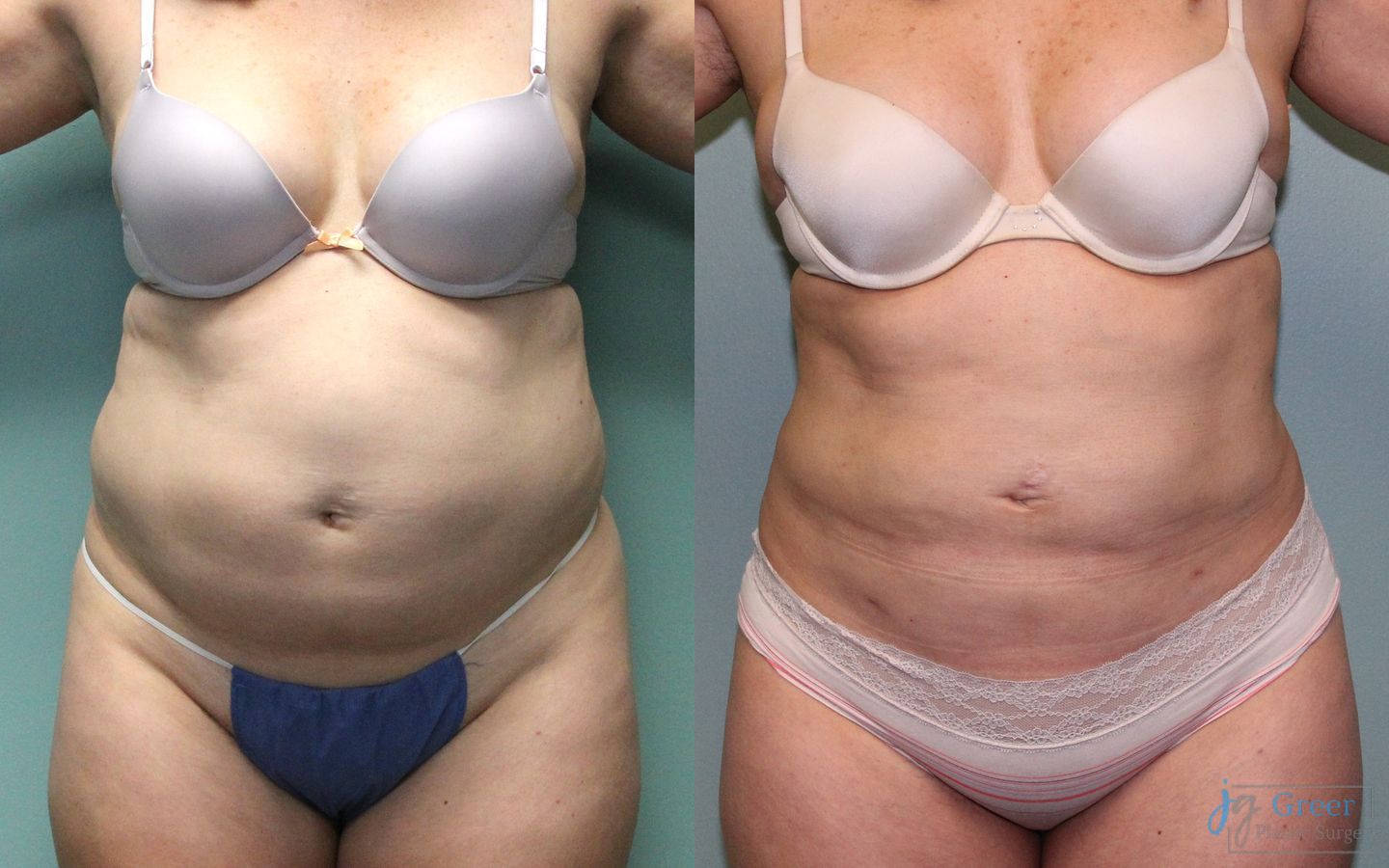 Before and after Liposuction case 19869