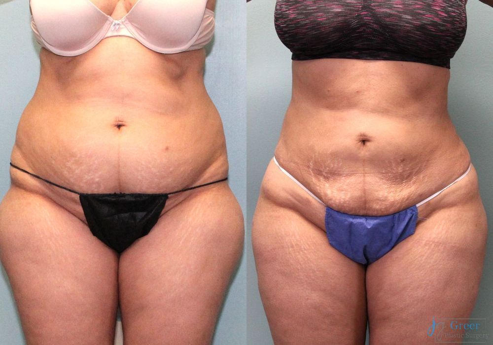 Lipo 360 - Thumbnail 3