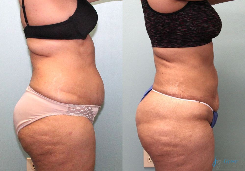 Lipo 360 - Thumbnail 2