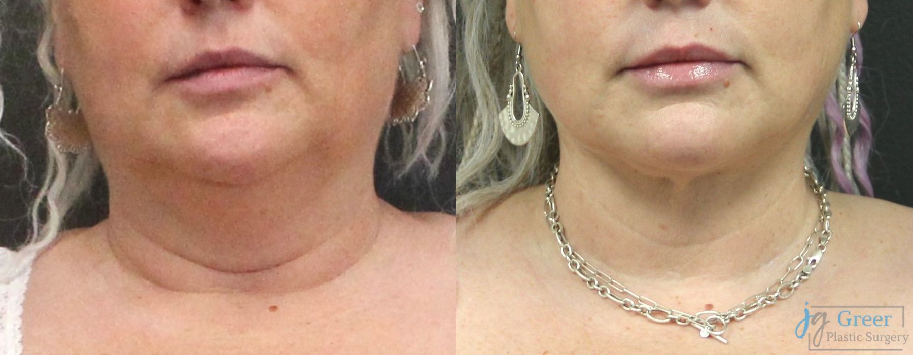 Liposuction - Case 2336