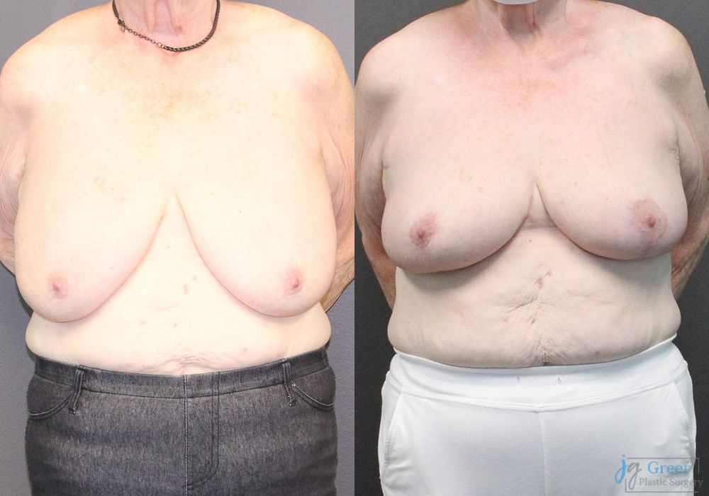 Mastopexy - Case 2383