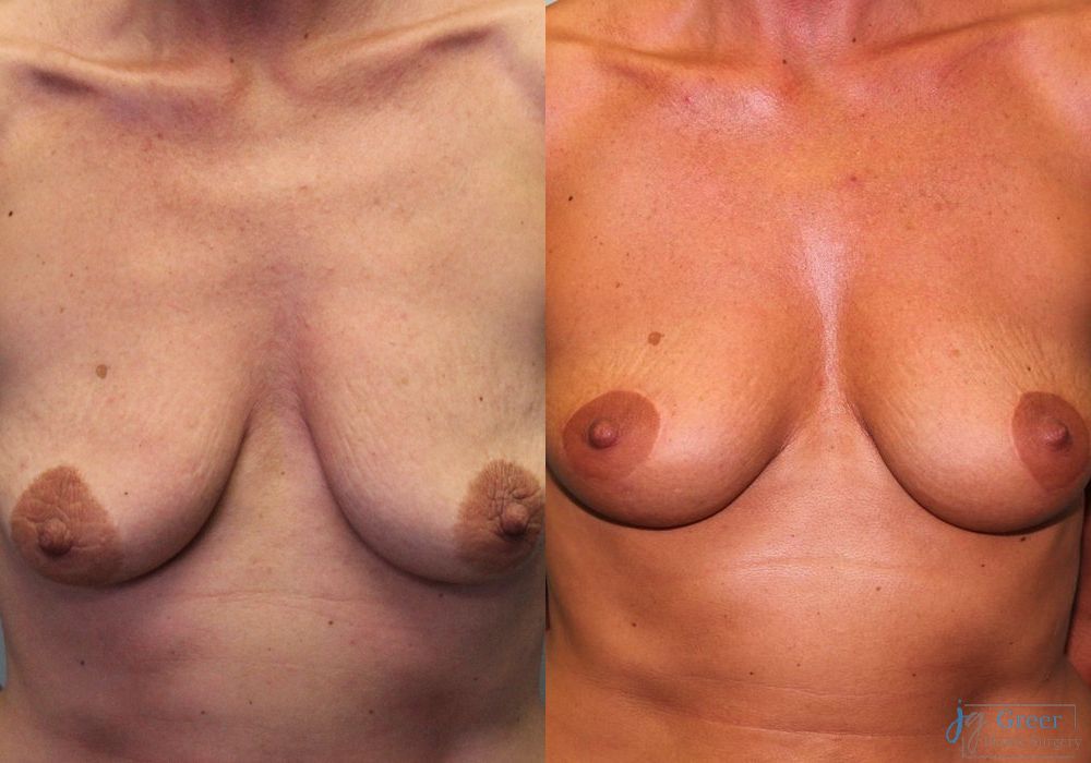 Mastopexy - Case 2386
