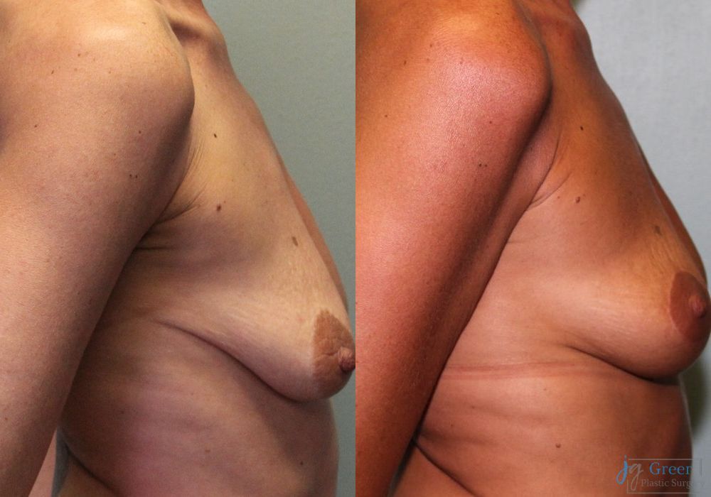 Mastopexy - Thumbnail 2