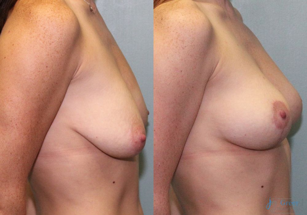 Mastopexy - Thumbnail 2