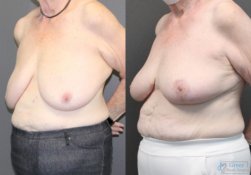 Mastopexy - Thumbnail 2