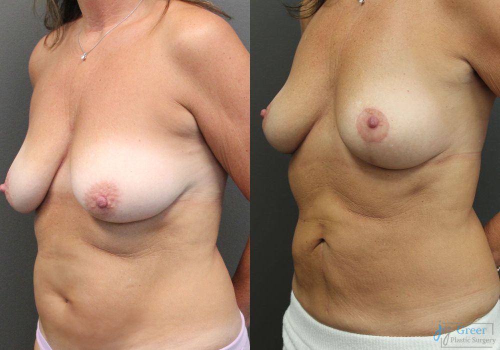 Before photo - Angle 2