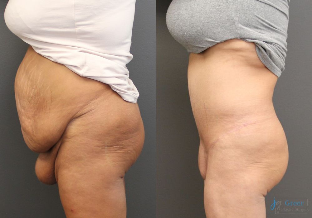 Before and after Monsplasty case 19853 - Angle 2