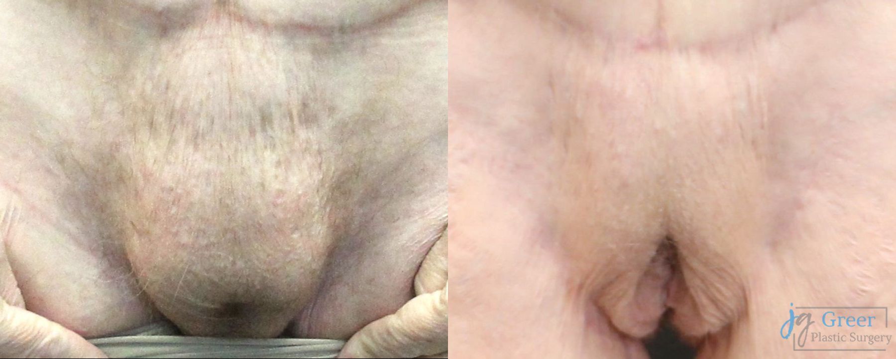 Before and after Monsplasty case 19904