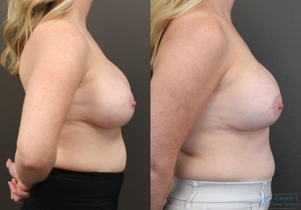 Revision or Removal of Implants - Thumbnail 2