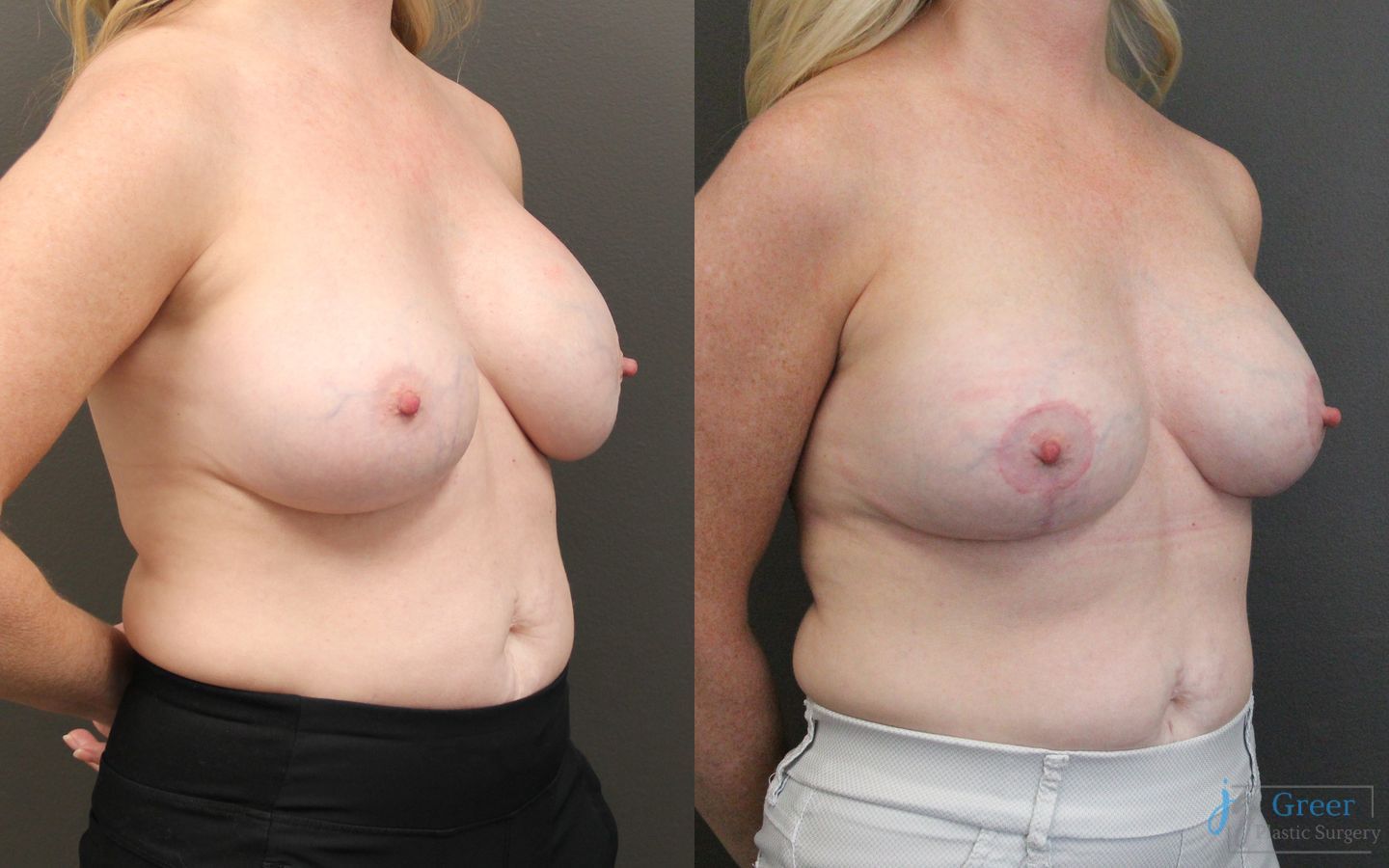 Before and after Revision or Removal of Implants case 19817 - Angle 3