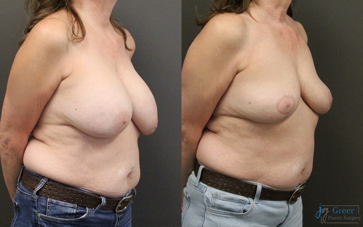 Before and after Revision or Removal of Implants case 41342 - Angle 2
