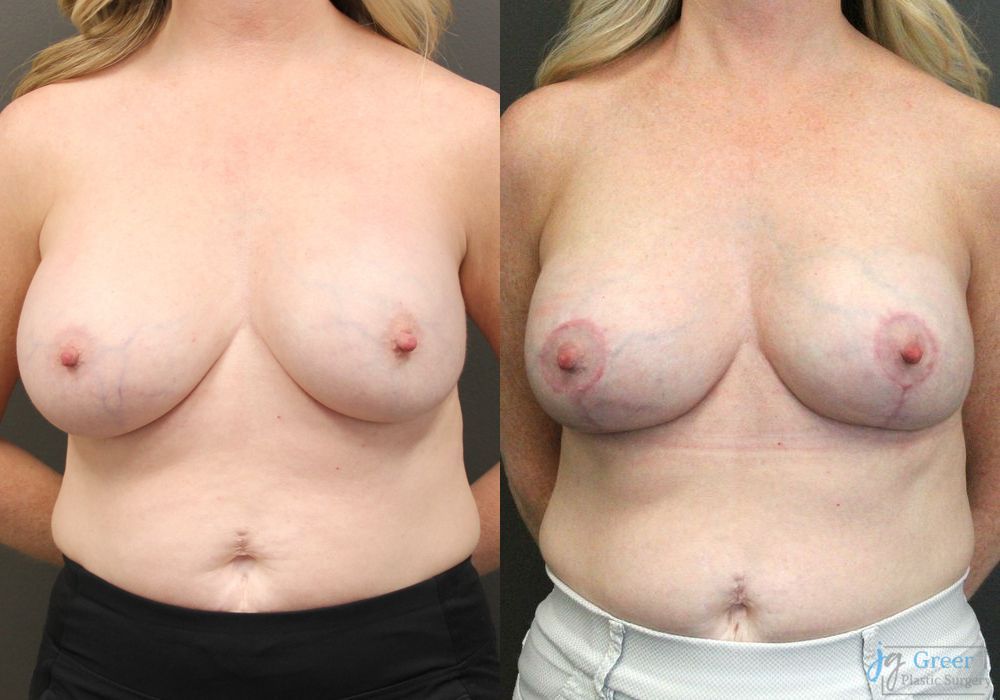 Revision or Removal of Implants - Case 2392