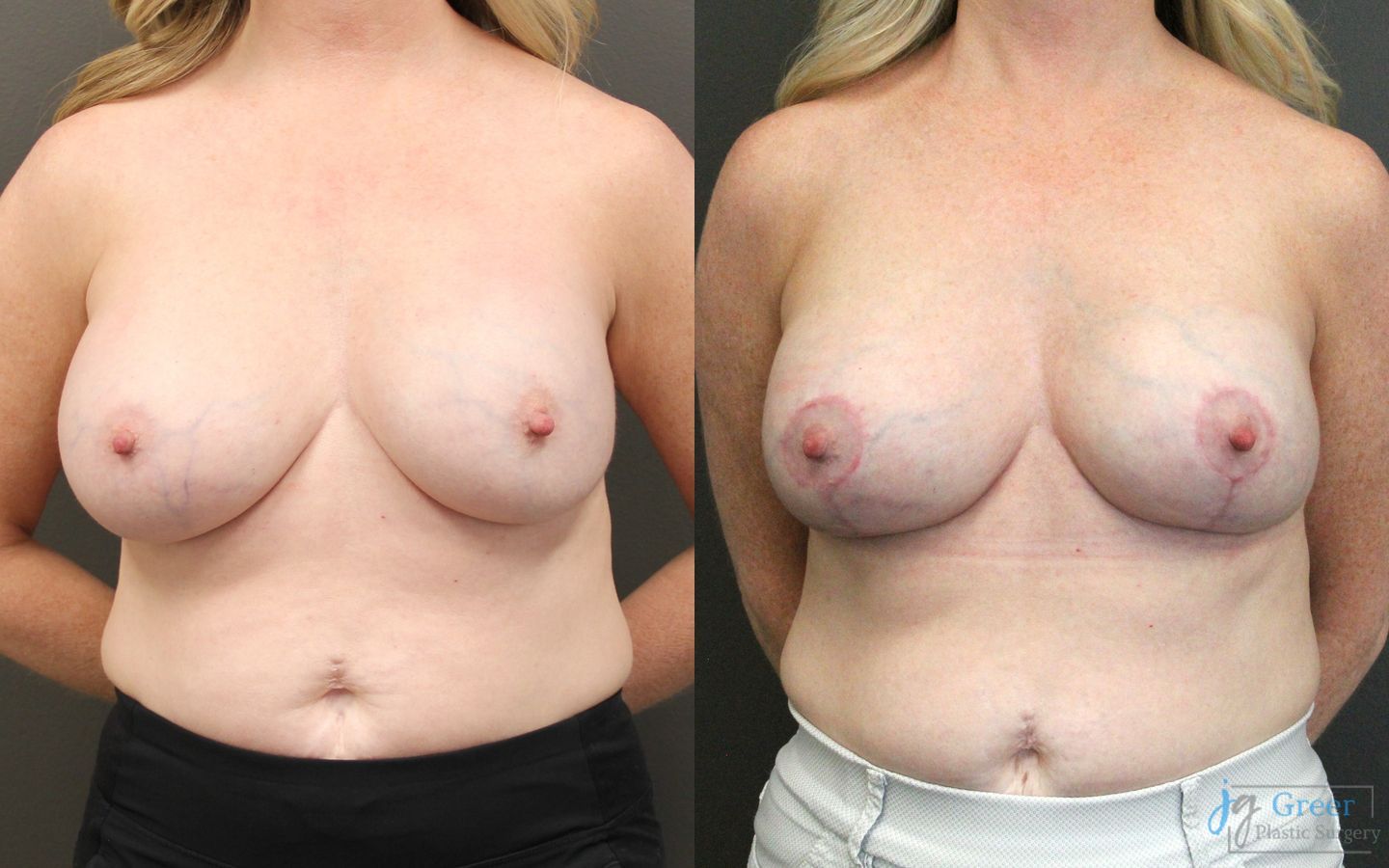 Before and after Revision or Removal of Implants case 19817