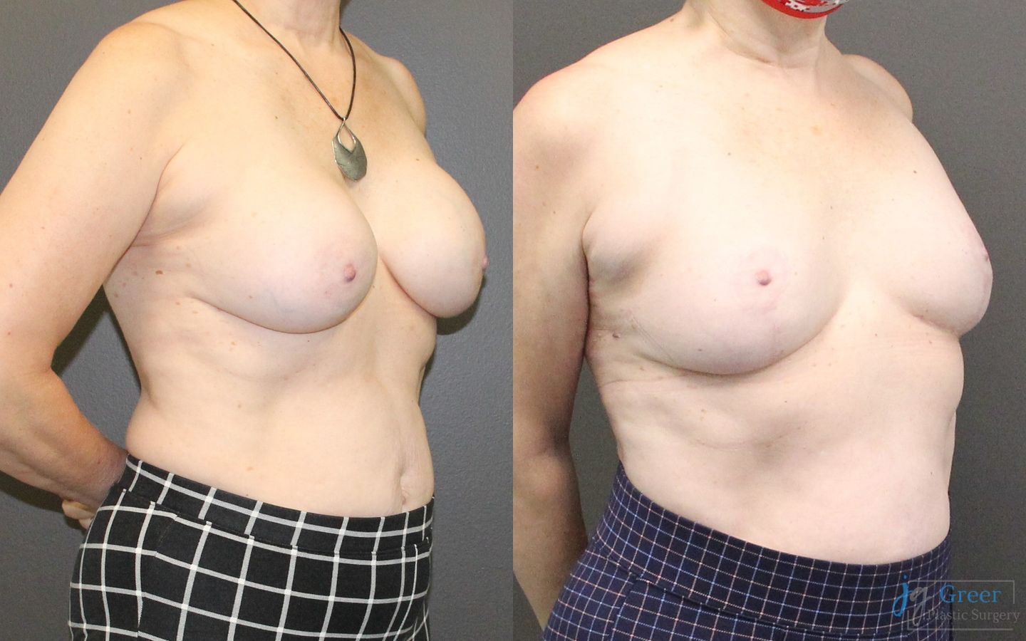 Before and after Revision or Removal of Implants case 19816 - Angle 2
