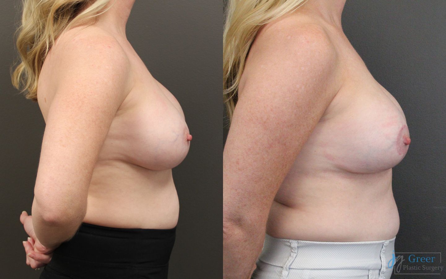 Before and after Revision or Removal of Implants case 19817 - Angle 2