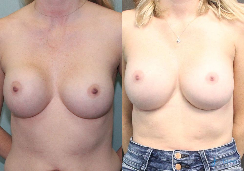 Revision or Removal of Implants - Case 2389