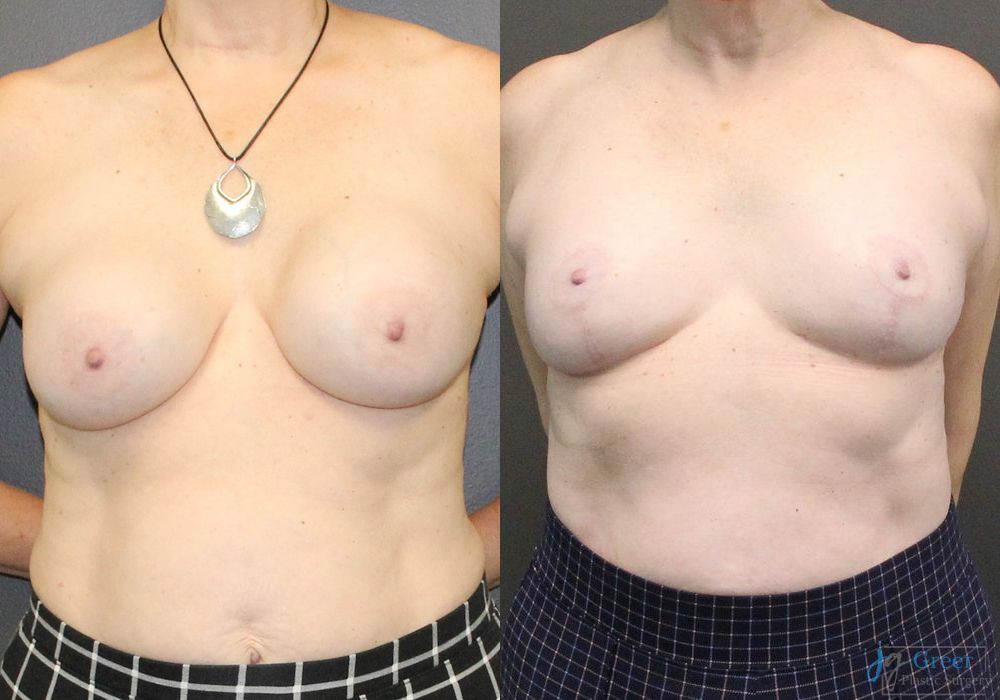 Revision or Removal of Implants - Case 2391