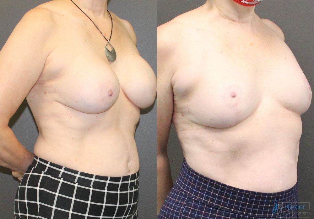 Revision or Removal of Implants - Thumbnail 2