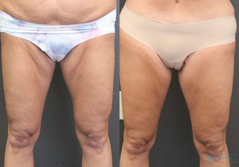 Thigh Lift - Case 2344