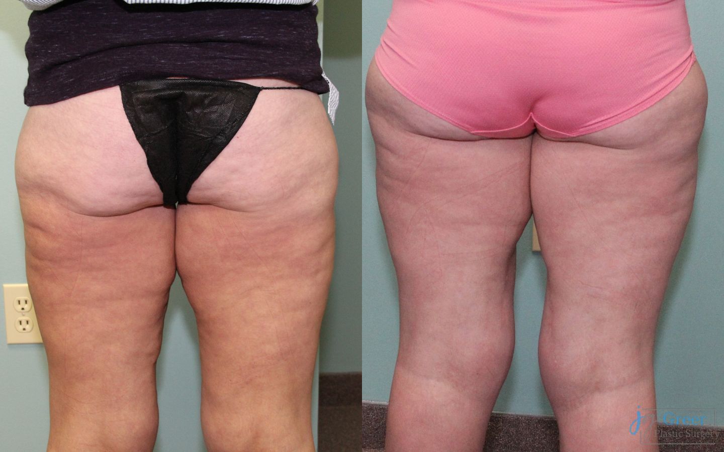 Before and after Brachioplasty case 19859 - Angle 2