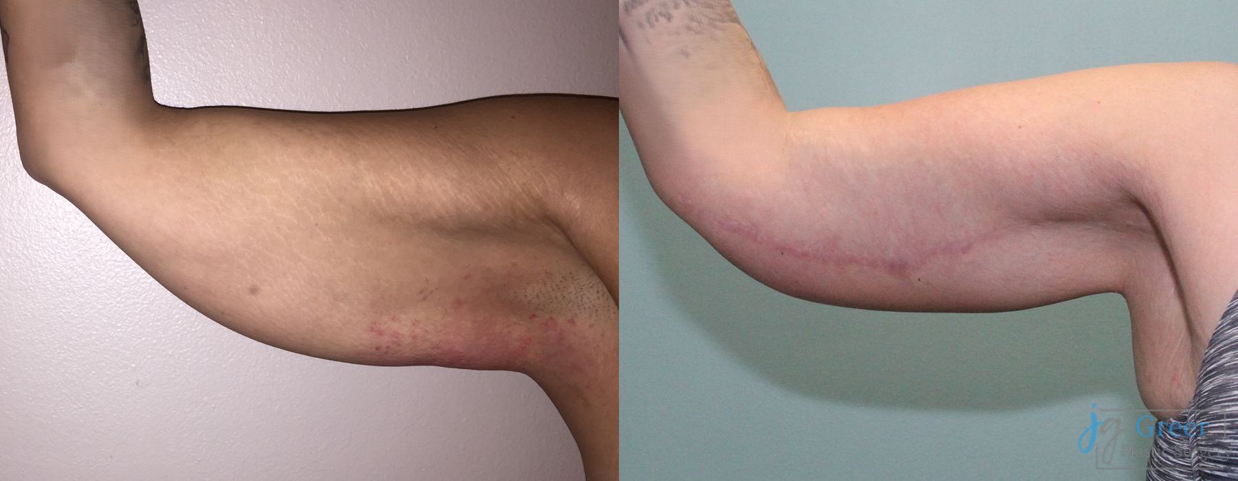 Before and after Brachioplasty case 19859 - Angle 3