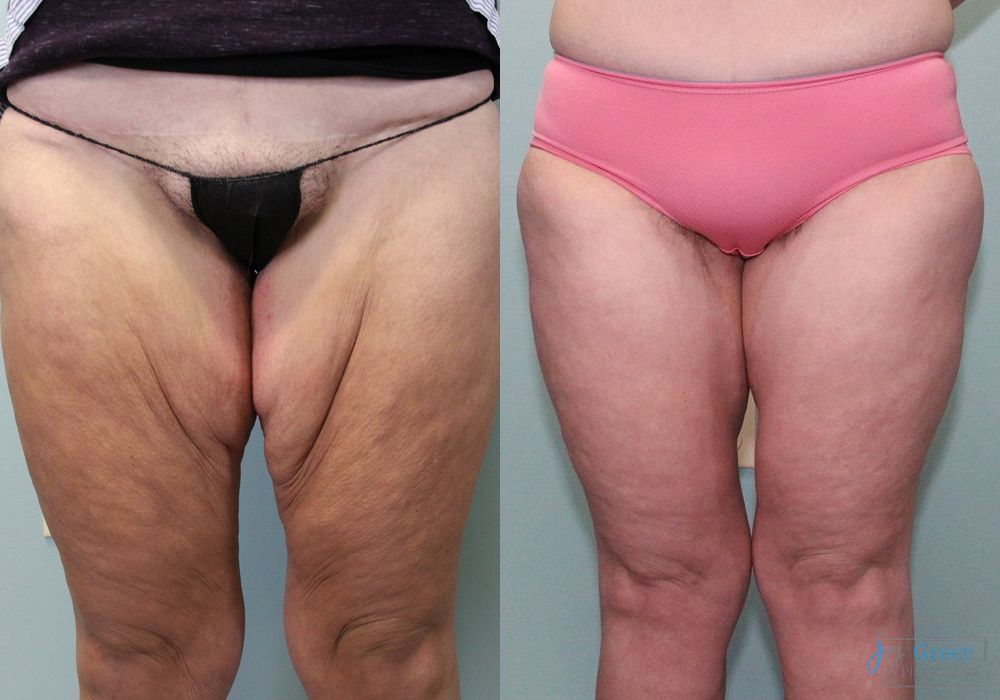Before and after Brachioplasty case 19859