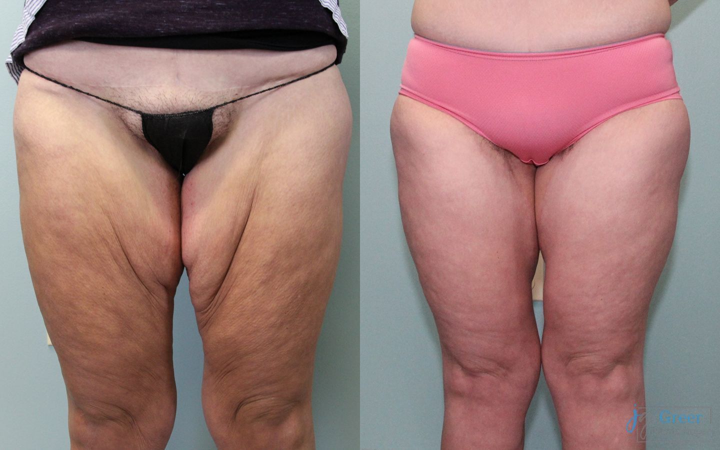 Before and after Brachioplasty case 19859