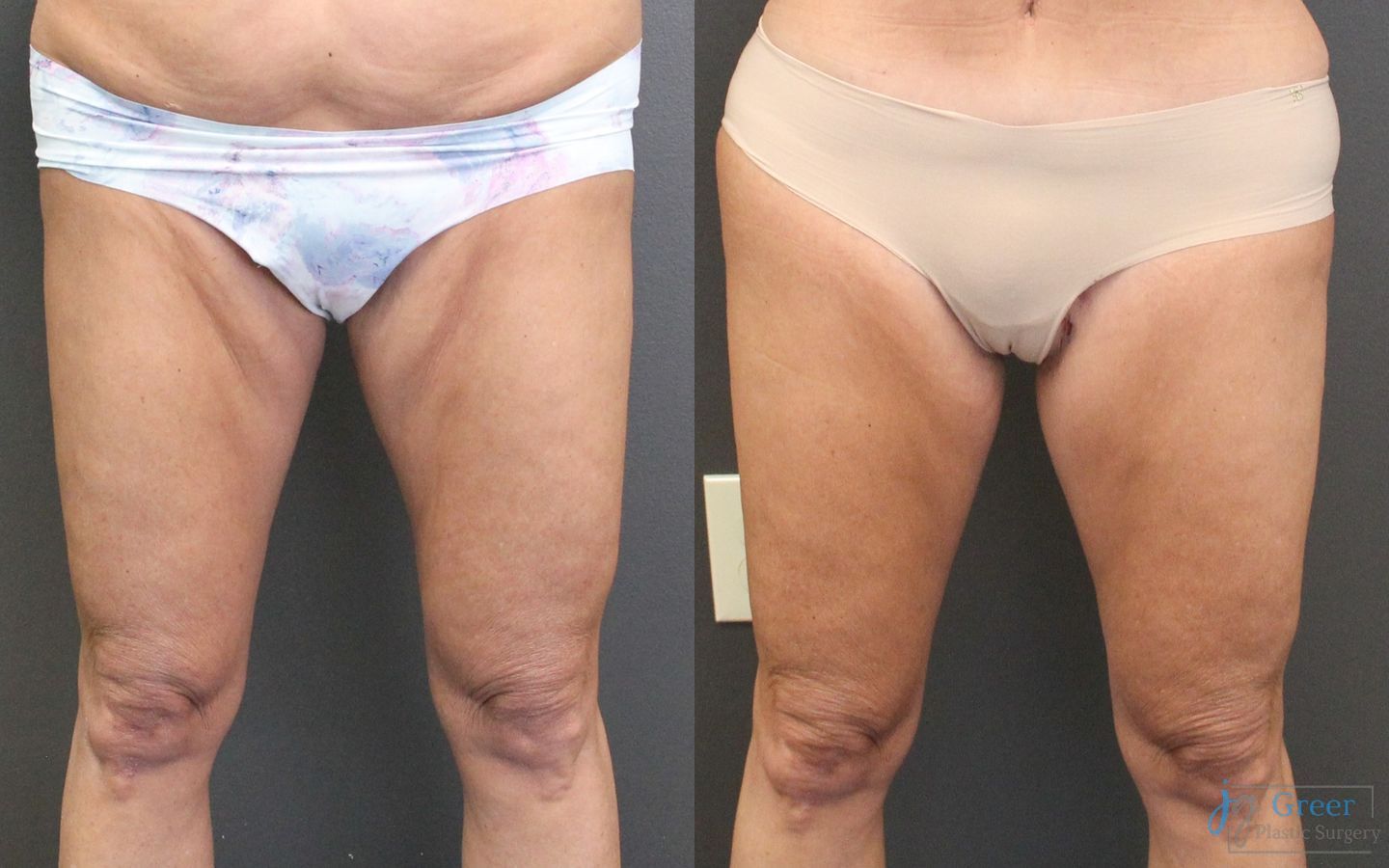 Before and after Thigh Lift case 19861