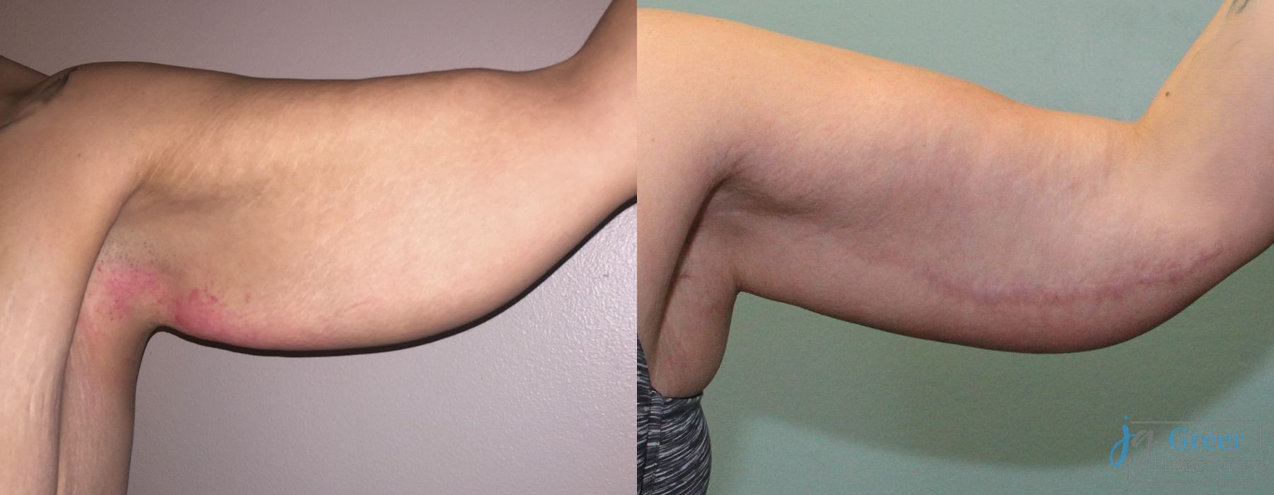 Before and after Brachioplasty case 19859 - Angle 4