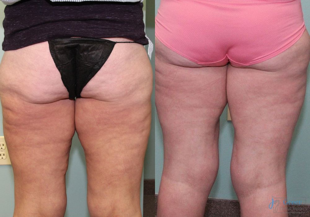 Before and after Brachioplasty case 19859 - Angle 2
