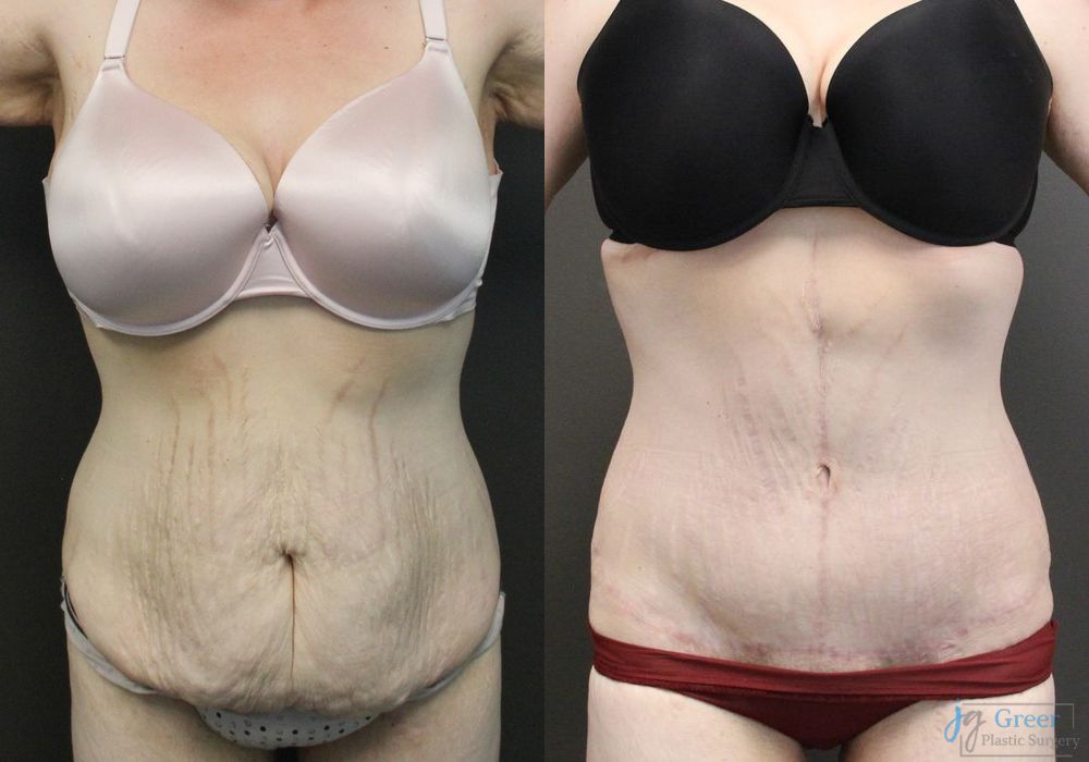 Tummy Tuck - Case 2347