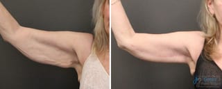 Before and after Thigh Lift case 41340 - Angle 1