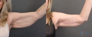 Before and after Thigh Lift case 41340 - Angle 2