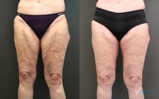 Before and after Thigh Lift case 41340 - Angle 3