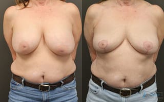 Before and after Revision or Removal of Implants case 41342 - Angle 1