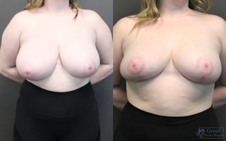 Before and after Breast Reduction case 19791 - Angle 1