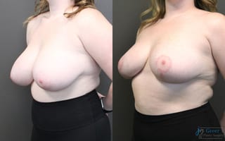 Before and after Breast Reduction case 19791 - Angle 2