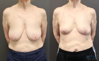 Before and after Breast Reduction case 19793 - Angle 1
